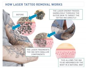 Tattoo Removal How Your Body Does the Work Vanish Tattoo