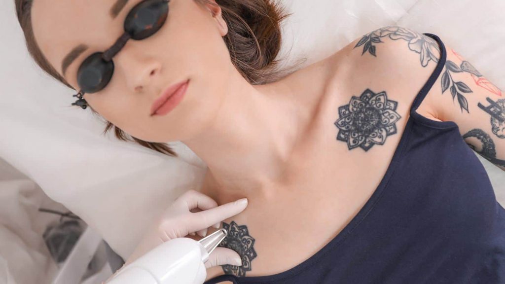 Which is the best tattoo removal method?